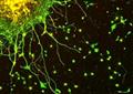 Common links between neurodegenerative diseases identified